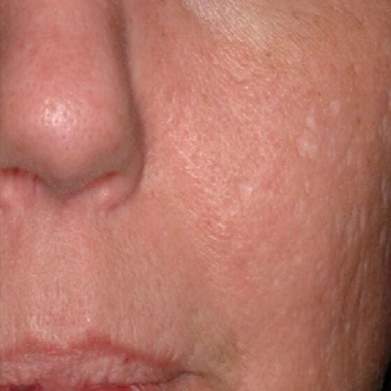 a close up of a cheek without hyperpigmentation and discoloration