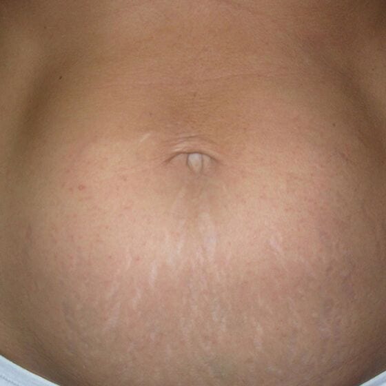 an image of someones stomach with greatly reduced stretch marks