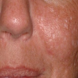 A close up of a woman's face with freckles receiving wellness services at a health spa.