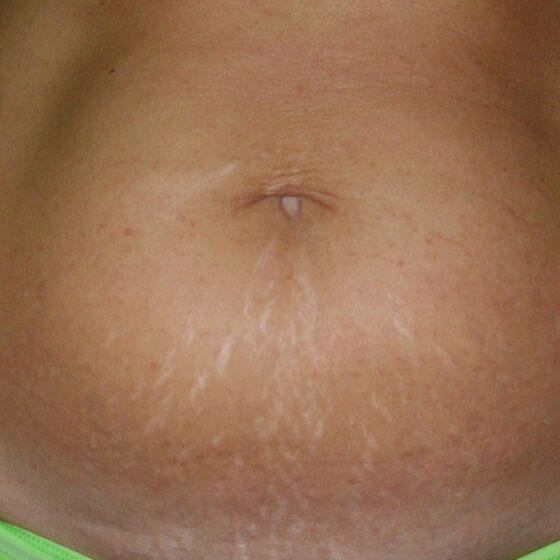 an image of someone's stomach with stretch marks