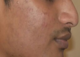close up of a man's cheek with much less acne and acne scarring