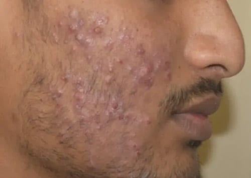close up of a man's cheek with intense acne and scarring