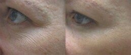 a before and after picture. In the before picture the woman has fine crows feet, in the after picture she does not