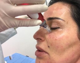 a woman receiving a microneedling treatment under her eyes