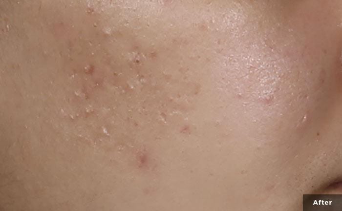 a close up image of a cheek with healing acne scars