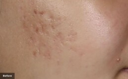 a close up of a cheek with deep acne scarring
