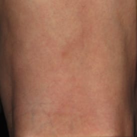 a close up image after spider vein treatment, with no spider vein left
