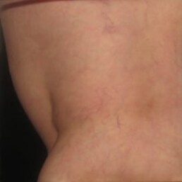 the same close up picture, but with very few, if any, spider veins left after treatment