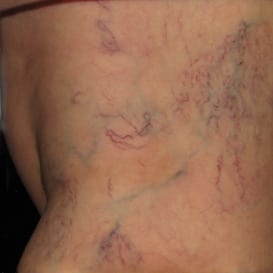 a close up image of blue and purple spider veins on the skin