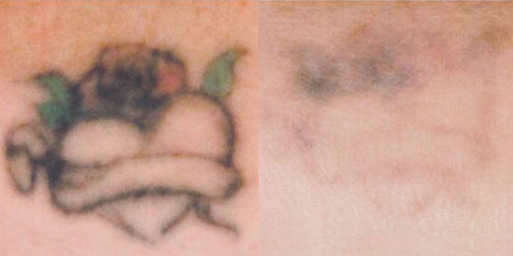 two side-by-side images of a tattoo before and after laser tattoo removal treatment