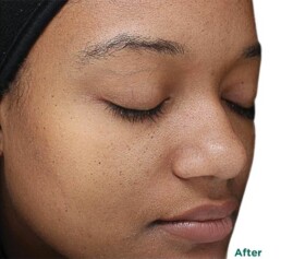 a close up image of a black woman's face after treatment, showing less discoloration and texture
