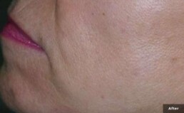 a close up of a cheek with no brown spots