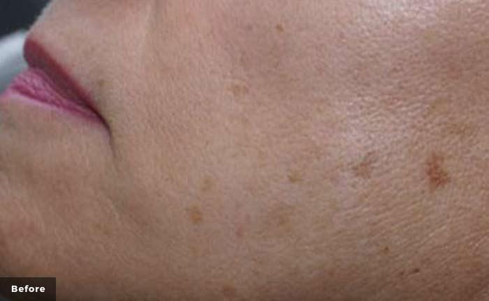 a close up of a cheek with dark brown aging spots