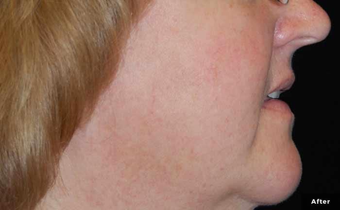a close up of a white womans cheek after treatment, with almost no red discoloration