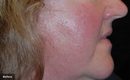 a close up image of a white woman's cheek that looks very red