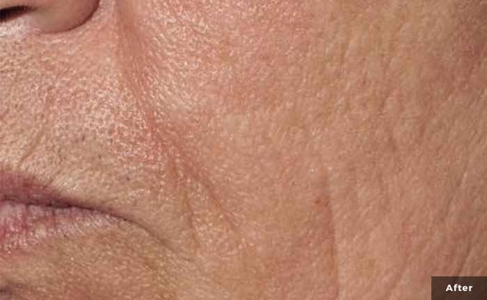 a close up of a cheek with considerably less severe wrinkles