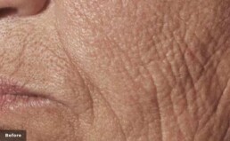 a close up of a cheek with lots of deep wrinkles