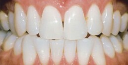 A close up of a person's teeth showcasing their white, healthy smile.