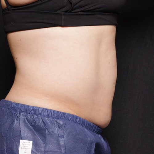 A woman's tummy undergoing liposuction at a Laser Center.