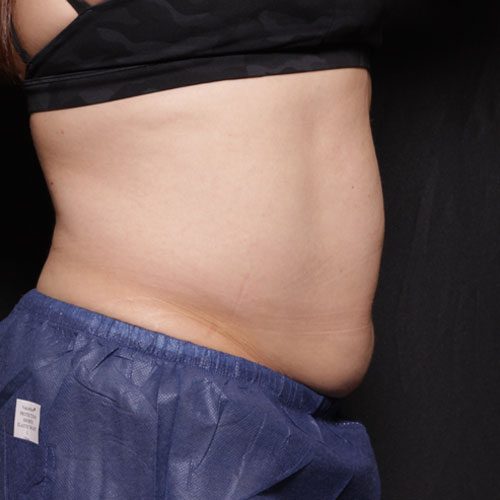 A woman's tummy after liposuction at Limelight Medical Spa.