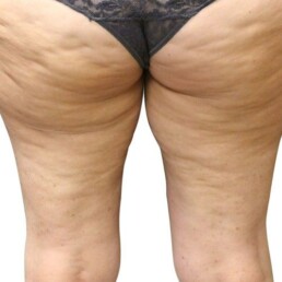 Experience the transformative results of liposuction on a woman's butt at our Health Spa in Cincinnati. Our wellness services will help you achieve your desired body shape and enhance your confidence.