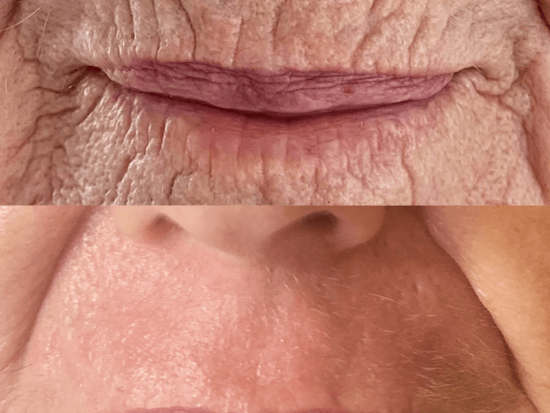 Plasma Pen lower facial lines before and after