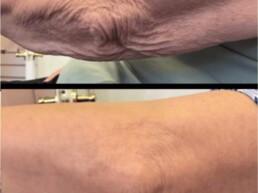 Plasma Pen body treatment before and after