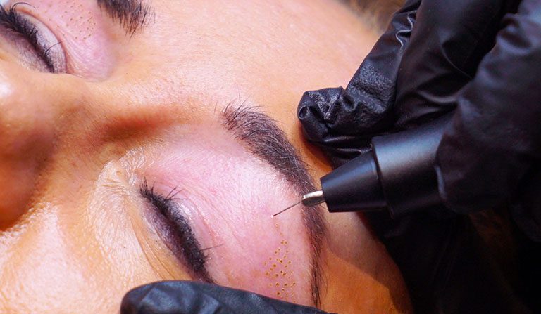 Plasma Pen treatment into upper eyelid