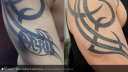 A man from Cincinnati with a tattoo on his arm undergoes tattoo removal at Limelight Medical Spa, known for its exceptional wellness services.