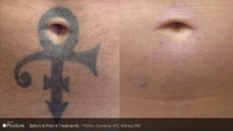 A man's tattoo before undergoing treatment at Limelight Medical Spa in Cincinnati.