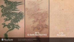 A photo of a tattoo before and after treatment at Limelight Medical Spa.