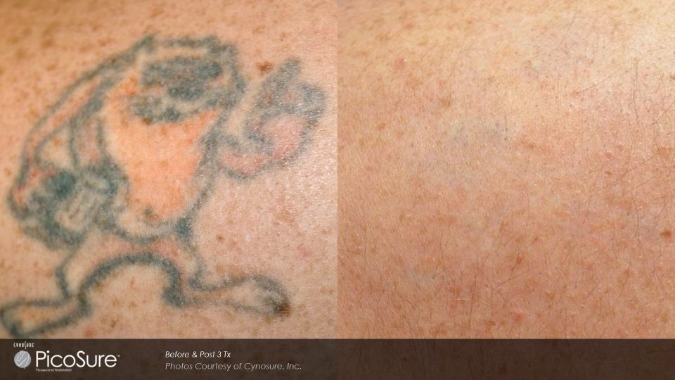 Before and after laser tattoo eraser