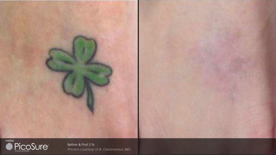 Cincinnati laser center offers Shamrock tattoo removal with remarkable before and after results.