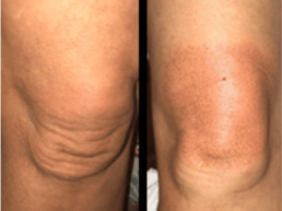 Two pictures showcasing a person's knee transformation at the Laser Center in Cincinnati.