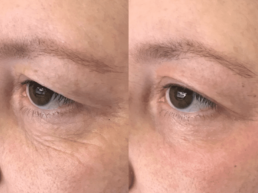A woman's face before and after a Limelight Medical Spa laser treatment.