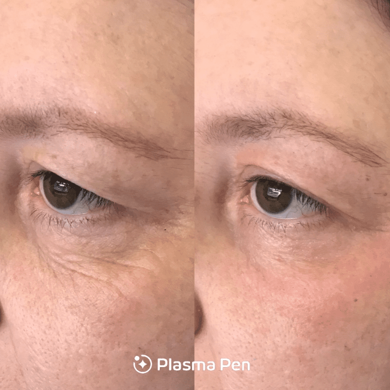Plasma Pen Limelight Laser & Medical Spa