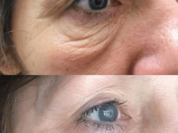 Before and after photo of a woman's eyes at a Laser Center.