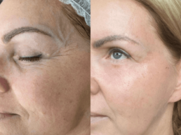 A woman's face before and after a plasma pen treatment at a Cincinnati wellness center.