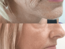A woman's face before and after a plasma pen treatment at Cincinnati's Limelight Medical Spa.