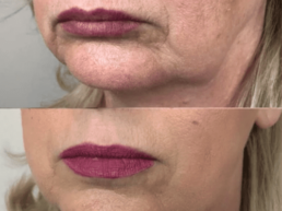 A woman's face before and after lip injections at a Health Spa.