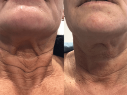 A woman's neck before and after Laser Center treatment.