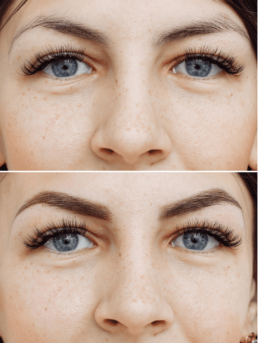 Before and after pictures of a woman's eyebrows at Limelight Medical Spa in Cincinnati.