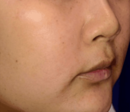 A woman's face before and after a facelift at Limelight Medical Spa in Cincinnati.