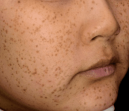 A young girl with freckles on her face enjoying wellness services at a health spa.