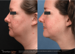 A woman's face before and after liposuction at a Cincinnati health spa.