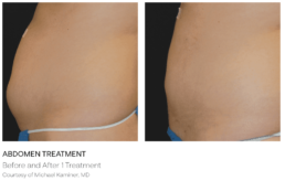Visit Limelight Medical Spa and Laser Center in Cincinnati for a transformative tummy tuck before and after treatment.