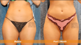 Before and after tummy tuck available at a Cincinnati health spa offering wellness services.