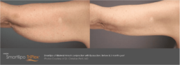 A woman's arm before and after a breast lift at Limelight Medical Spa in Cincinnati.