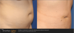 Laser Center before and after tummy tuck.