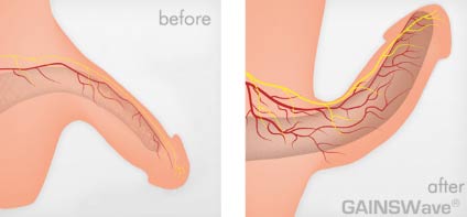 The before and after images of a patient's abdomen following a gastric sleeve procedure are provided by the Health Spa in Cincinnati.